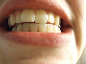 como evitar las caries