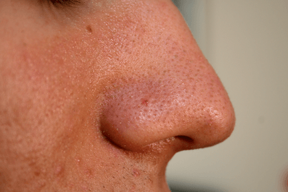 Grano dentro de la nariz